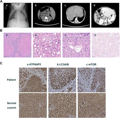 Expanding the phenotype and metabolic basis of ATP6AP2-congenital disorder of glycosylation in a Chinese patient with a novel variant c.185G>A (p.Gly62Glu)